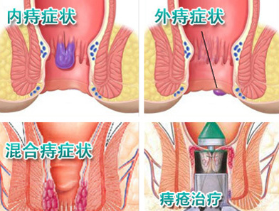 混合痔