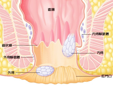 外痔