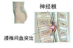 <b>治疗腰间盘突出牵引好吗 ?有哪些疗法?</b>