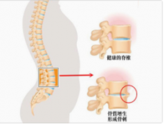 <b>生“骨刺”了，你该怎么办?</b>