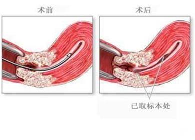 人流手术