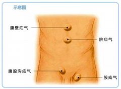 <b>疝气的危害有哪些方面</b>