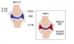 <b>别傻傻分不清！关节疼痛肿胀，小心滑膜炎</b>